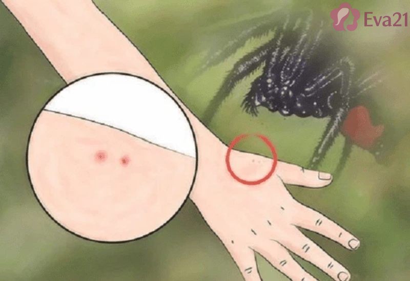 Những biện pháp xử lý khi bị nhện cắn hay nhất