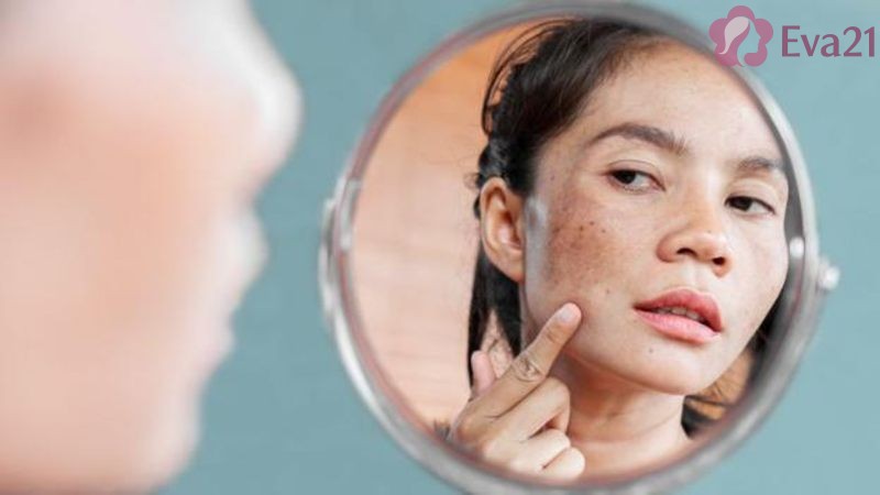 Cách điều trị nám và tăng sắc tố sau sinh an toàn và hiệu quả nhất