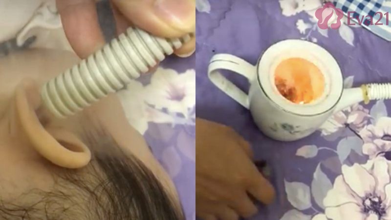 Cách phòng tránh chứng viêm tai giữa bằng sáp ong hiệu quả