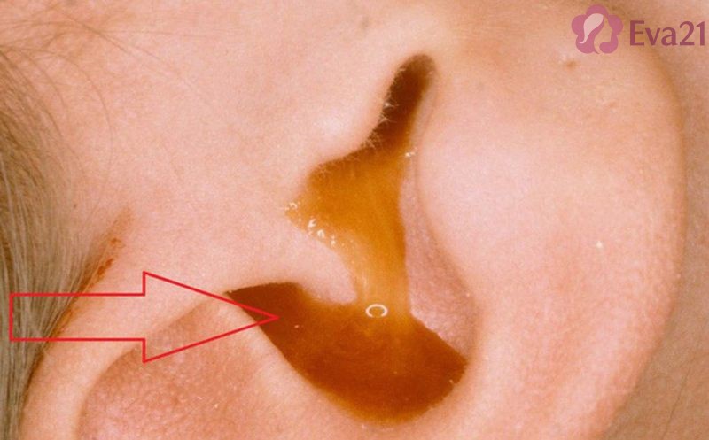 Những vấn đề cần lưu ý về mẹo chữa viêm tai giữa bằng sáp ong